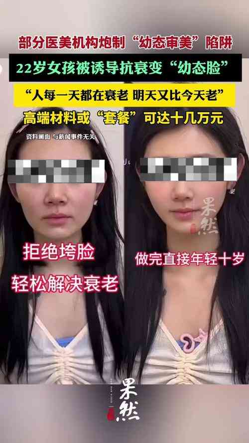 22岁女孩被诱导打造“幼态脸”：医美焦虑如何精准营销年轻人？